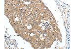 The image on the left is immunohistochemistry of paraffin-embedded Human breast cancer tissue using CSB-PA288553(FSHR Antibody) at dilution 1/70, on the right is treated with fusion protein. (Original magnification: 