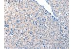 The image on the left is immunohistochemistry of paraffin-embedded Human cervical cancer tissue using CSB-PA288592(ACOT8 Antibody) at dilution 1/20, on the right is treated with fusion protein. (Original magnification: 
