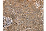 The image on the left is immunohistochemistry of paraffin-embedded Human cervical cancer tissue using CSB-PA288812(CLEC16A Antibody) at dilution 1/45, on the right is treated with synthetic peptide. (Original magnification: 