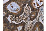 The image on the left is immunohistochemistry of paraffin-embedded Human colon cancer tissue using CSB-PA288891(FGF18 Antibody) at dilution 1/40, on the right is treated with fusion protein. (Original magnification: 
