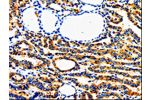 The image on the left is immunohistochemistry of paraffin-embedded Human thyroid cancer tissue using CSB-PA289421(AIMP2 Antibody) at dilution 1/50, on the right is treated with fusion protein. (Original magnification: 