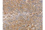 The image on the left is immunohistochemistry of paraffin-embedded Human breast cancer tissue using CSB-PA289722(GFAP Antibody) at dilution 1/25, on the right is treated with fusion protein. (Original magnification: 