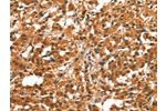 The image on the left is immunohistochemistry of paraffin-embedded Human thyroid cancer tissue using CSB-PA289766(CYP2B6 Antibody) at dilution 1/30, on the right is treated with synthetic peptide. (Original magnification: 