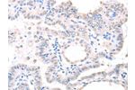 The image on the left is immunohistochemistry of paraffin-embedded Human thyroid cancer tissue using CSB-PA289847(APEX1 Antibody) at dilution 1/20, on the right is treated with fusion protein. (Original magnification: 