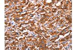 The image on the left is immunohistochemistry of paraffin-embedded Human thyroid cancer tissue using CSB-PA289923(GAS8 Antibody) at dilution 1/40, on the right is treated with synthetic peptide. (Original magnification: 