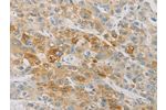 The image on the left is immunohistochemistry of paraffin-embedded Human liver cancer tissue using CSB-PA289963(ACSL4 Antibody) at dilution 1/25, on the right is treated with fusion protein. (Original magnification: 