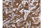 The image on the left is immunohistochemistry of paraffin-embedded Human liver cancer tissue using CSB-PA290047(FGF21 Antibody) at dilution 1/20, on the right is treated with fusion protein. (Original magnification: 