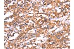 The image on the left is immunohistochemistry of paraffin-embedded Human thyroid cancer tissue using CSB-PA290137(GABBR1 Antibody) at dilution 1/30, on the right is treated with synthetic peptide. (Original magnification: 