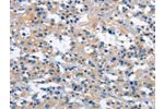 The image on the left is immunohistochemistry of paraffin-embedded Human thyroid cancer tissue using CSB-PA290331(GAS2 Antibody) at dilution 1/30, on the right is treated with fusion protein. (Original magnification: 