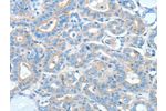 The image on the left is immunohistochemistry of paraffin-embedded Human thyroid cancer tissue using CSB-PA290707(AGO2 Antibody) at dilution 1/20, on the right is treated with fusion protein. (Original magnification: 