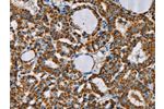 The image on the left is immunohistochemistry of paraffin-embedded Human thyroid cancer tissue using CSB-PA290810(CMC4 Antibody) at dilution 1/25, on the right is treated with fusion protein. (Original magnification: 