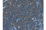 The image on the left is immunohistochemistry of paraffin-embedded Human Lymphoma tissue using CSB-PA291126(CNTNAP3 Antibody) at dilution 1/40, on the right is treated with synthetic peptide. (Original magnification: 