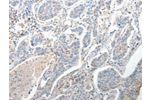 The image on the left is immunohistochemistry of paraffin-embedded Human lung cancer tissue using CSB-PA291867(FOXD1  Antibody) at dilution 1/25, on the right is treated with synthetic peptide. (Original magnification: 