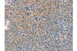 The image on the left is immunohistochemistry of paraffin-embedded Human liver cancer tissue using CSB-PA291937(BRCA1 Antibody) at dilution 1/35, on the right is treated with fusion protein. (Original magnification: 
