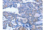 The image on the left is immunohistochemistry of paraffin-embedded Human thyroid cancer tissue using CSB-PA292270(ACVR2B Antibody) at dilution 1/25, on the right is treated with fusion protein. (Original magnification: 