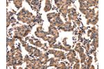The image on the left is immunohistochemistry of paraffin-embedded Human breast cancer tissue using CSB-PA292680(CGA Antibody) at dilution 1/65, on the right is treated with fusion protein. (Original magnification: 