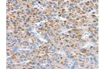 The image on the left is immunohistochemistry of paraffin-embedded Human liver cancer tissue using CSB-PA292985(CCS Antibody) at dilution 1/30, on the right is treated with synthetic peptide. (Original magnification: 