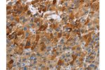 The image on the left is immunohistochemistry of paraffin-embedded Human liver cancer tissue using CSB-PA293047(CCR9 Antibody) at dilution 1/40, on the right is treated with fusion protein. (Original magnification: 