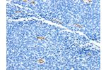 The image on the left is immunohistochemistry of paraffin-embedded Human ovarian cancer tissue using CSB-PA293186(ADIPOQ Antibody) at dilution 1/15, on the right is treated with fusion protein. (Original magnification: 