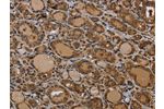 The image on the left is immunohistochemistry of paraffin-embedded Human thyroid cancer tissue using CSB-PA293314(GJB4 Antibody) at dilution 1/50, on the right is treated with synthetic peptide. (Original magnification: 