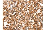 The image on the left is immunohistochemistry of paraffin-embedded Human thyroid cancer tissue using CSB-PA293420(DDAH2 Antibody) at dilution 1/20, on the right is treated with synthetic peptide. (Original magnification: 