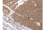 The image on the left is immunohistochemistry of paraffin-embedded Human ovarian cancer tissue using CSB-PA293526(GEMIN2 Antibody) at dilution 1/25, on the right is treated with synthetic peptide. (Original magnification: 