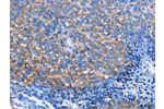 The image on the left is immunohistochemistry of paraffin-embedded Human ovarian cancer tissue using CSB-PA293996(CXCL3 Antibody) at dilution 1/25, on the right is treated with fusion protein. (Original magnification: 
