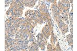 The image on the left is immunohistochemistry of paraffin-embedded Human ovarian cancer tissue using CSB-PA294012(COL4A1 Antibody) at dilution 1/30, on the right is treated with synthetic peptide. (Original magnification: 