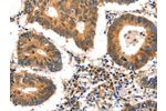 The image on the left is immunohistochemistry of paraffin-embedded Human colon cancer tissue using CSB-PA294342(GDF6 Antibody) at dilution 1/25, on the right is treated with synthetic peptide. (Original magnification: 