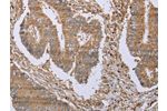 The image on the left is immunohistochemistry of paraffin-embedded Human colon cancer tissue using CSB-PA295162(FHL1 Antibody) at dilution 1/20, on the right is treated with fusion protein. (Original magnification: 