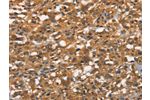The image on the left is immunohistochemistry of paraffin-embedded Human thyroid cancer tissue using CSB-PA295215(APOC4 Antibody) at dilution 1/20, on the right is treated with synthetic peptide. (Original magnification: 
