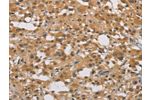 The image on the left is immunohistochemistry of paraffin-embedded Human thyroid cancer tissue using CSB-PA295249(DDX43 Antibody) at dilution 1/40, on the right is treated with fusion protein. (Original magnification: 