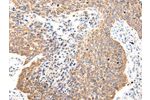 The image on the left is immunohistochemistry of paraffin-embedded Human lung cancer tissue using CSB-PA295305(COL8A2 Antibody) at dilution 1/20, on the right is treated with synthetic peptide. (Original magnification: 
