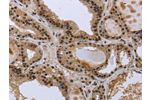 The image on the left is immunohistochemistry of paraffin-embedded Human colon cancer tissue using CSB-PA295309(GCKR Antibody) at dilution 1/50, on the right is treated with fusion protein. (Original magnification: 