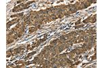 The image on the left is immunohistochemistry of paraffin-embedded Human gastic cancer tissue using CSB-PA296813(CTSE Antibody) at dilution 1/40, on the right is treated with fusion protein. (Original magnification: 