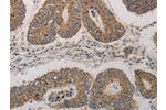 The image on the left is immunohistochemistry of paraffin-embedded Human colon cancer tissue using CSB-PA297162(CDKN1A Antibody) at dilution 1/20, on the right is treated with fusion protein. (Original magnification: 