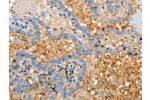 The image on the left is immunohistochemistry of paraffin-embedded Human thyroid cancer tissue using CSB-PA297198(APOH Antibody) at dilution 1/30, on the right is treated with fusion protein. (Original magnification: 