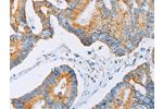 The image on the left is immunohistochemistry of paraffin-embedded Human colon cancer tissue using CSB-PA297340(ACAA2 Antibody) at dilution 1/30, on the right is treated with fusion protein. (Original magnification: 