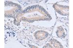 The image on the left is immunohistochemistry of paraffin-embedded Human colon cancer tissue using CSB-PA297536(ACMSD Antibody) at dilution 1/15, on the right is treated with fusion protein. (Original magnification: 
