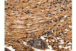 The image on the left is immunohistochemistry of paraffin-embedded Human colon cancer tissue using CSB-PA297927(ANXA5 Antibody) at dilution 1/40, on the right is treated with fusion protein. (Original magnification: 