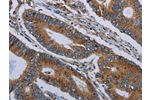 The image on the left is immunohistochemistry of paraffin-embedded Human colon cancer tissue using CSB-PA297988(FPR3 Antibody) at dilution 1/20, on the right is treated with synthetic peptide. (Original magnification: 