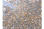 The image on the left is immunohistochemistry of paraffin-embedded Human cervical cancer tissue using CSB-PA298431(BRE Antibody) at dilution 1/30, on the right is treated with fusion protein. (Original magnification: 
