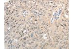 The image on the left is immunohistochemistry of paraffin-embedded Human ovarian cancer tissue using CSB-PA298683(ASCL1 Antibody) at dilution 1/30, on the right is treated with synthetic peptide. (Original magnification: 