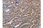 The image on the left is immunohistochemistry of paraffin-embedded Human thyroid cancer tissue using CSB-PA298726(AKR1B10 Antibody) at dilution 1/20, on the right is treated with fusion protein. (Original magnification: 