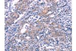 The image on the left is immunohistochemistry of paraffin-embedded Human gastic cancer tissue using CSB-PA299070(FGF16 Antibody) at dilution 1/30, on the right is treated with synthetic peptide. (Original magnification: 