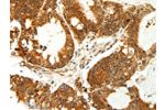 The image on the left is immunohistochemistry of paraffin-embedded Human colon cancer tissue using CSB-PA299234(COX7B Antibody) at dilution 1/60, on the right is treated with fusion protein. (Original magnification: 
