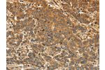 The image on the left is immunohistochemistry of paraffin-embedded Human liver cancer tissue using CSB-PA299262(EDNRA Antibody) at dilution 1/30, on the right is treated with synthetic peptide. (Original magnification: 