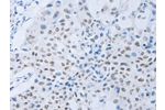 The image on the left is immunohistochemistry of paraffin-embedded Human lung cancer tissue using CSB-PA300271(CSF1R Antibody) at dilution 1/45, on the right is treated with synthetic peptide. (Original magnification: 