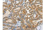 The image on the left is immunohistochemistry of paraffin-embedded Human thyroid cancer tissue using CSB-PA305079(ASCC1 Antibody) at dilution 1/30, on the right is treated with fusion protein. (Original magnification: 