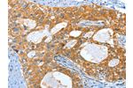 The image on the left is immunohistochemistry of paraffin-embedded Human cervical cancer tissue using CSB-PA311389(AMHR2 Antibody) at dilution 1/40, on the right is treated with fusion protein. (Original magnification: 